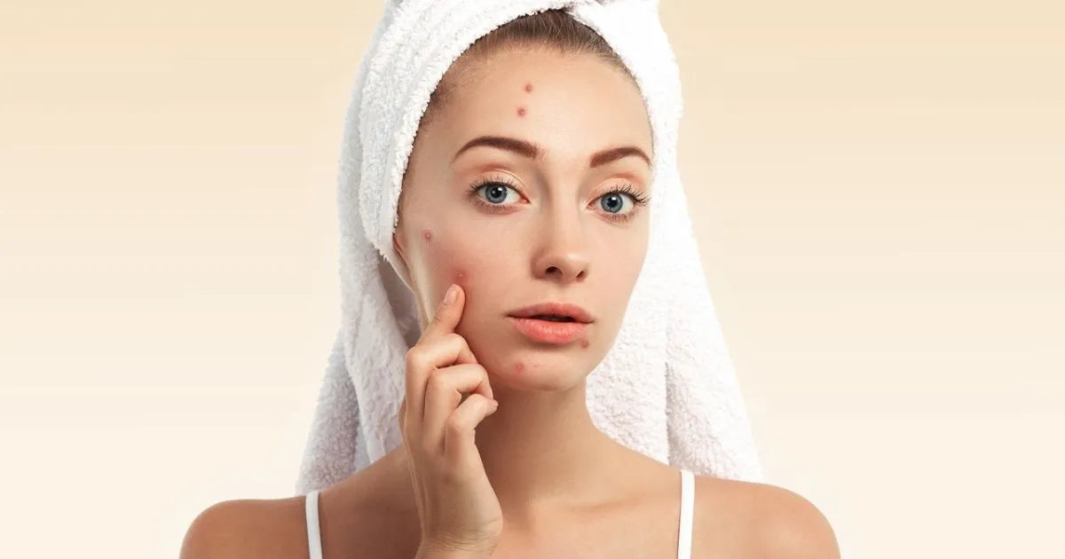 Pimple Cream DIY Recipe - Refined Naturals